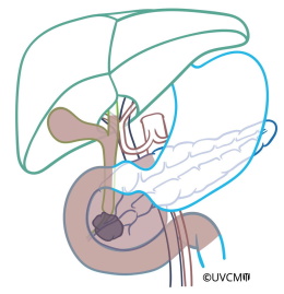 Extent of resection for partial removal of the pancreas