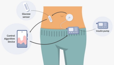 Modern insulin administration with closed control loop