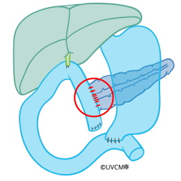 Suture of the pancreas to the small intestine loop