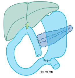 Reconstruction after partial removal of the pancreas