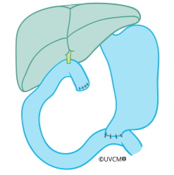 Reconstruction after complete removal of the pancreas