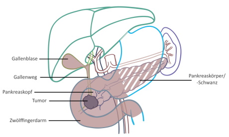Extent of resection for partial and complete removal of the pancreas